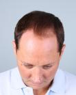 After Hair Transplant&nbsp;Midscalp